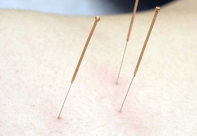 Acupunctura: un tratament complementar în cancer