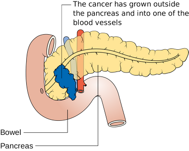 Cum se poate preveni cancerul de pancreas?